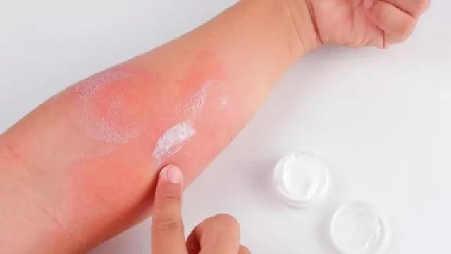 ¿Cómo tratar la dermatitis atópica en verano? Especialista da algunas recomendaciones 