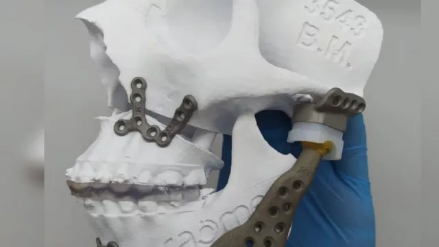 Nacen las cirugías 4.0: la empresa cordobesa Raomed desarrolla soluciones médicas a medida con tecnología 3D (que ya se usan en India)