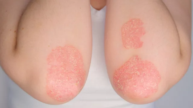 Psoriasis y artritis psoriásica: enfermedades invisibles que impactan la salud, el trabajo y la calidad de vida