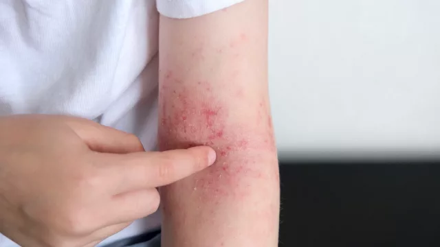 Dermatitis atópica: la enfermedad que puede quitar el sueño y afectar la calidad de vida