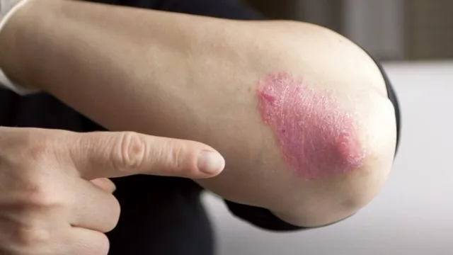 Psoriasis, una enfermedad más allá de la piel: ¿qué hábitos pueden desencadenarla?